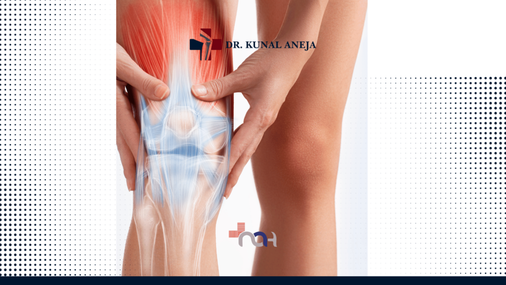 Knee Replacement Surgeon in Delhi