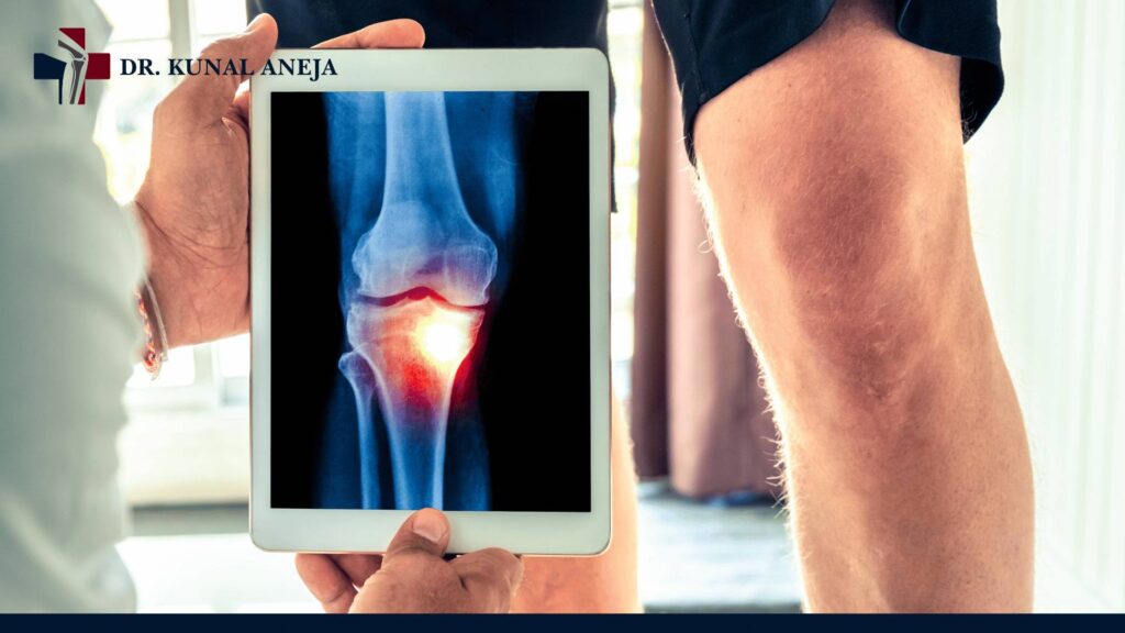 Knee Replacement Surgeon in Delhi
