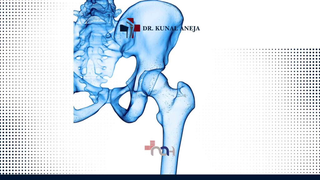 Hip Replacement Surgeon in Delhi