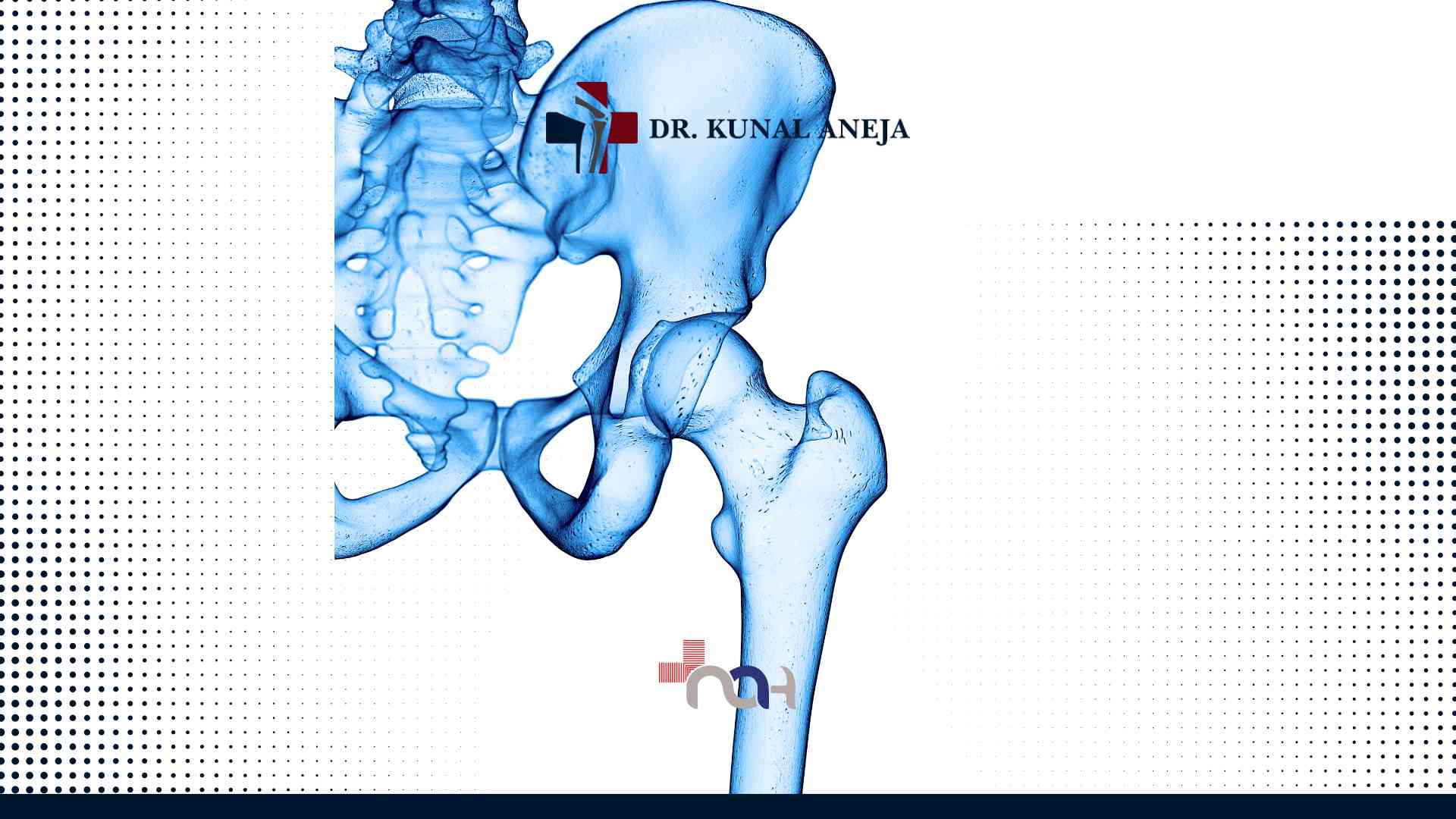 Hip Replacement Surgeon in Delhi