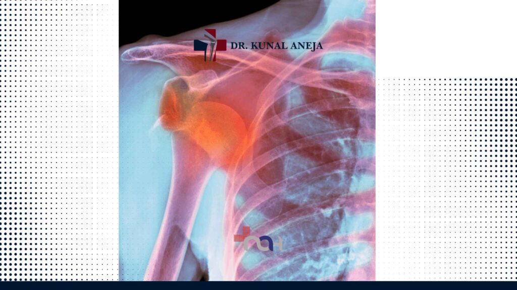 Shoulder Dislocation Treatment in India