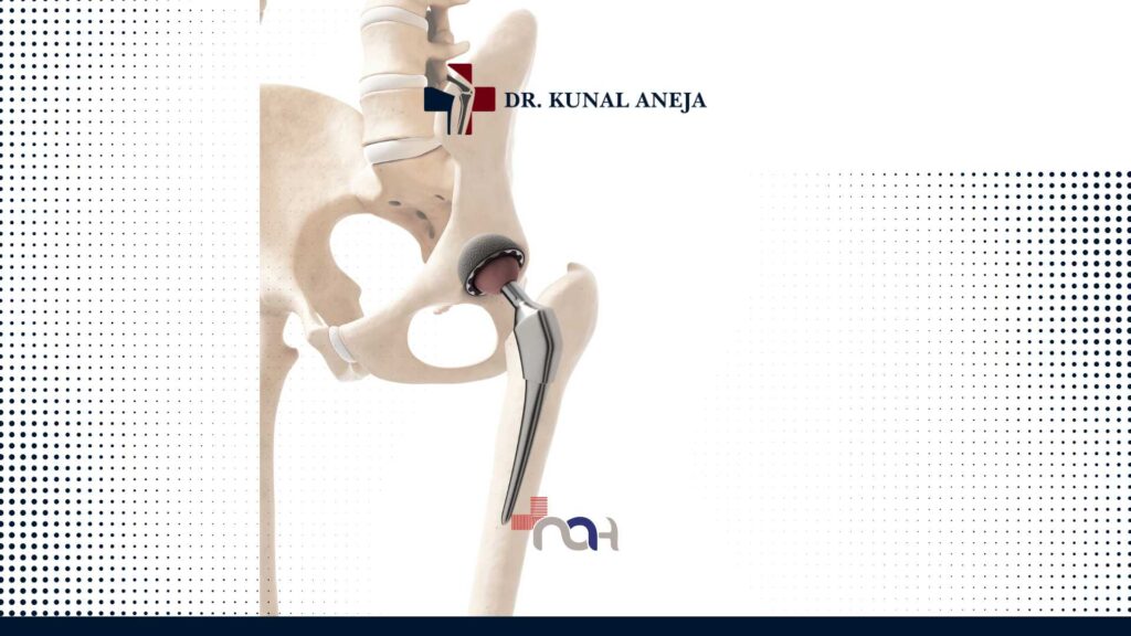 Hip Replacement Surgeon in India
