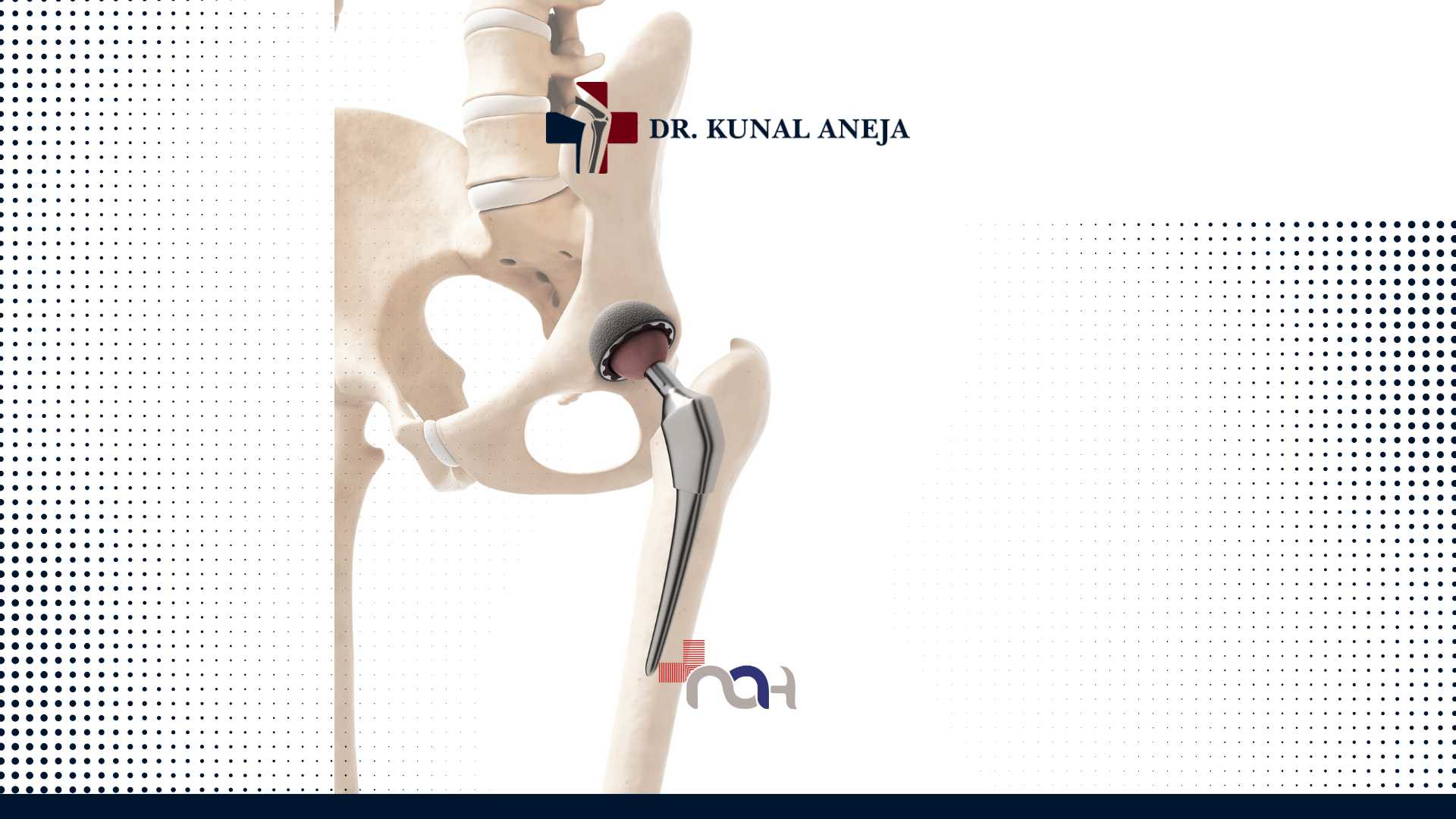 Hip Replacement Surgeon in India
