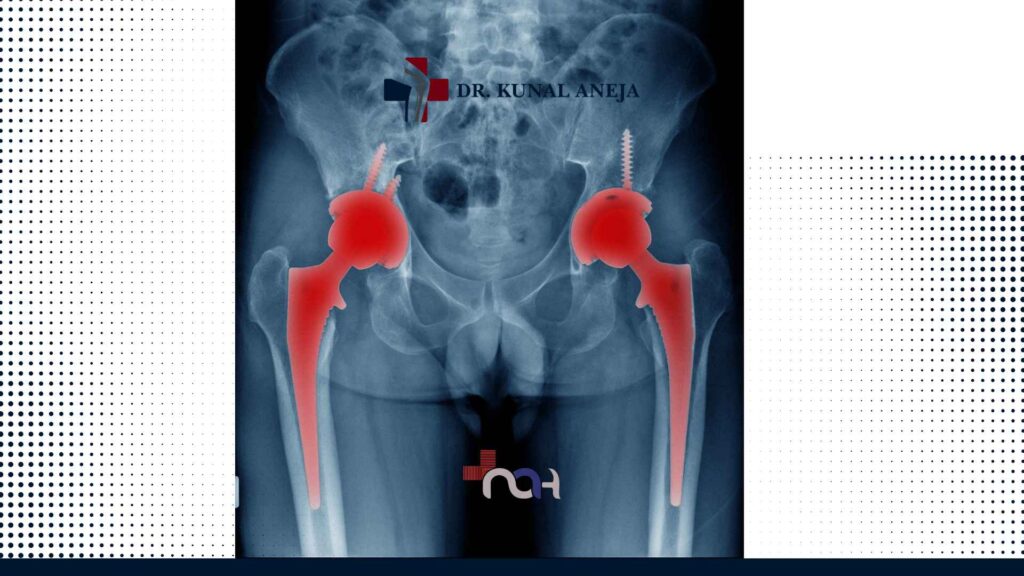 Hip Replacement Surgeon in Delhi