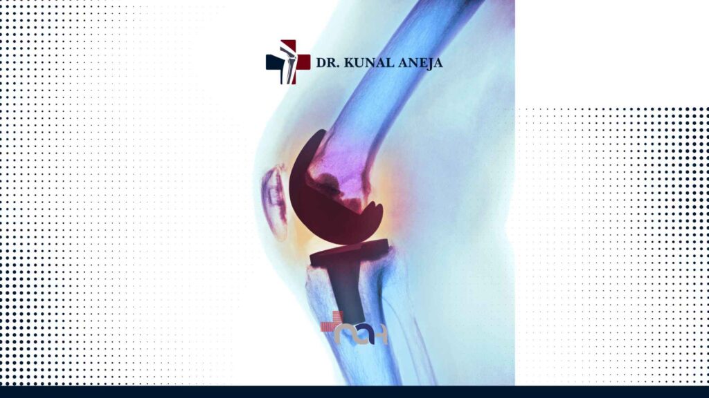 Knee Replacement Surgeon in Delhi