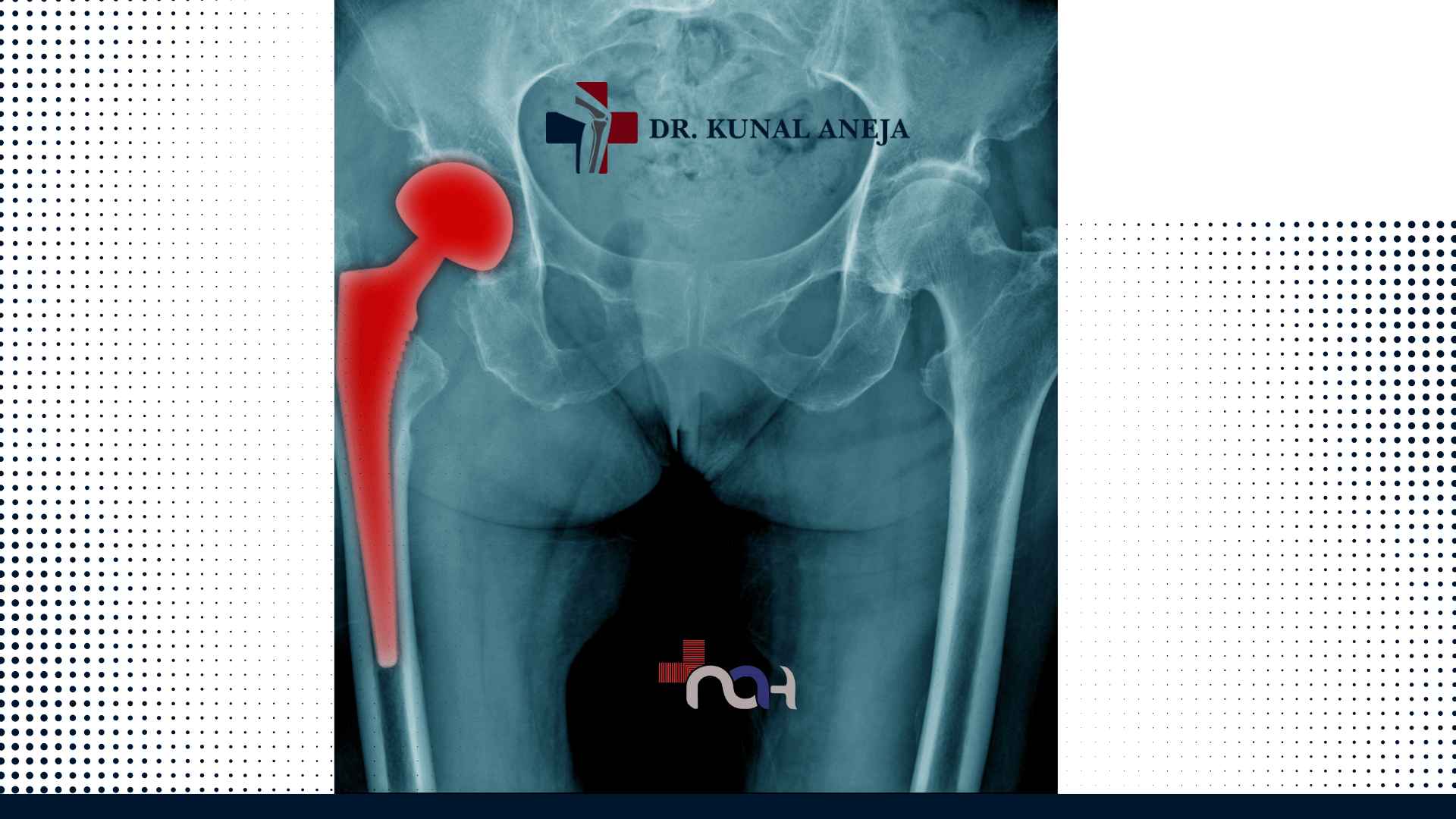 Hip Replacement Surgeon in India