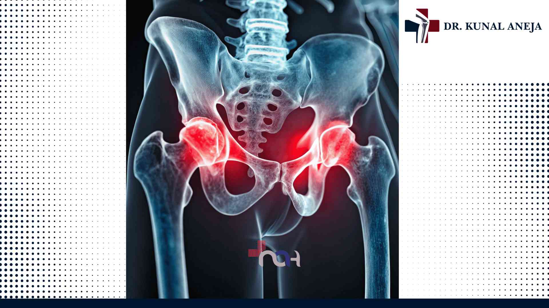 Total Hip Replacement in Delhi
