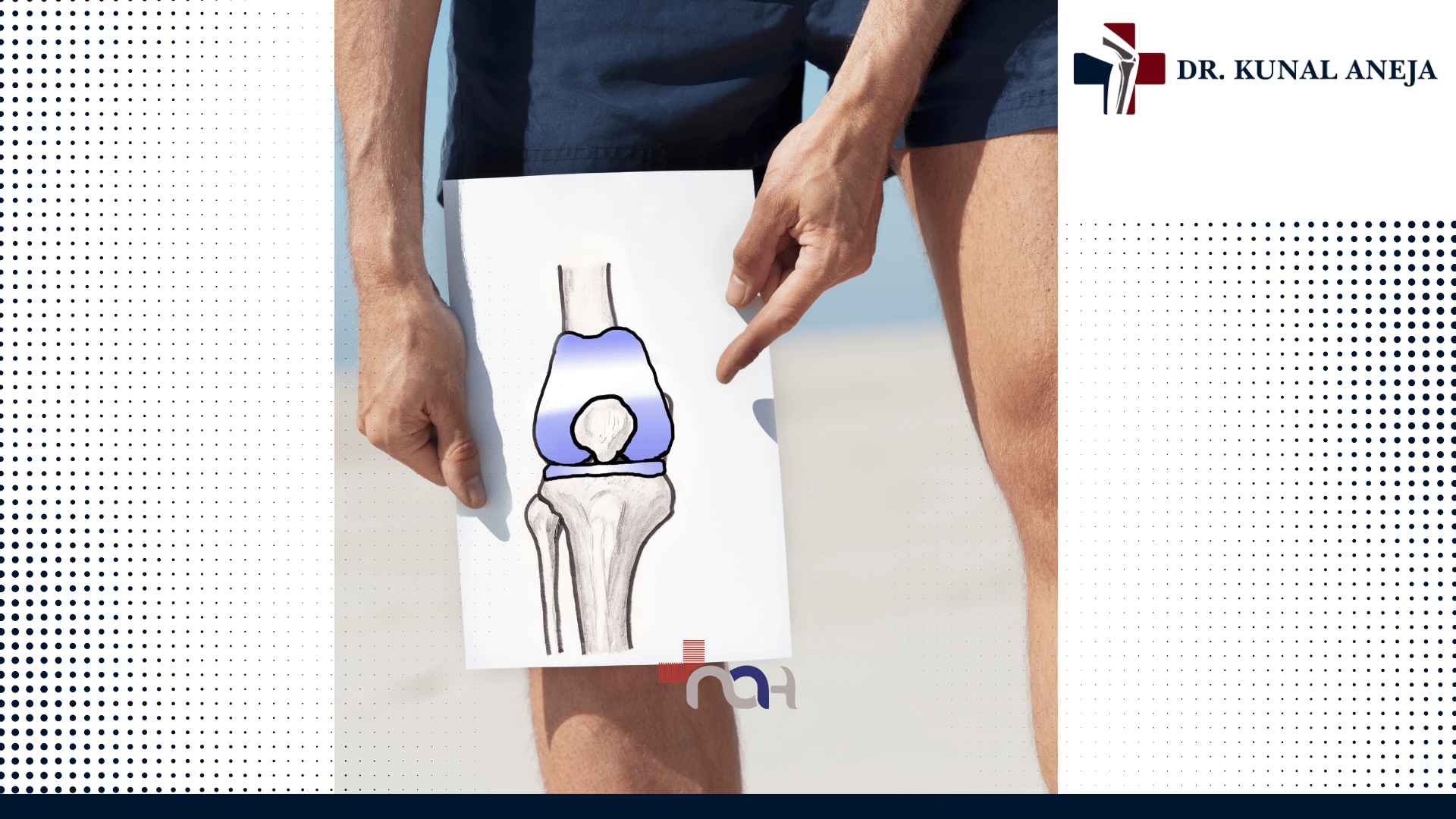 Knee Replacement Surgeon in Delhi