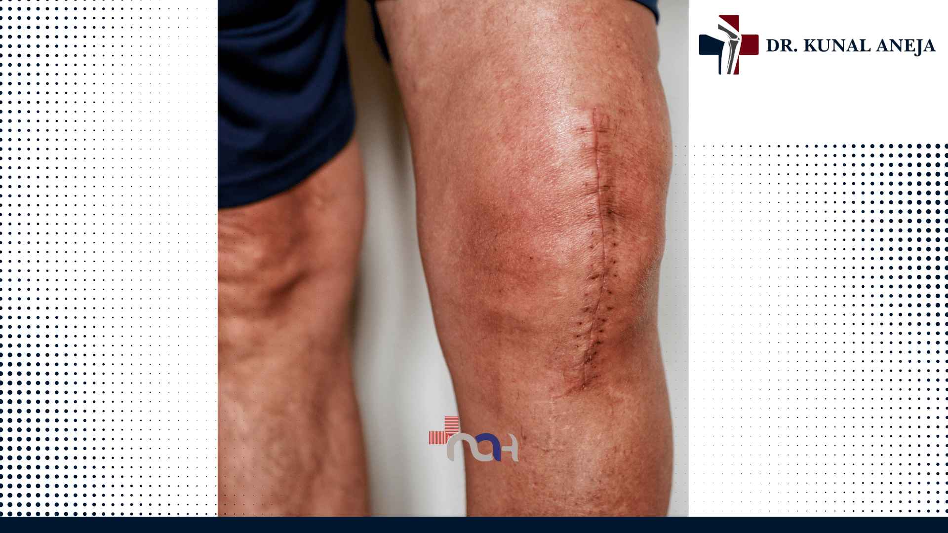 Best knee replacement surgeon in Delhi