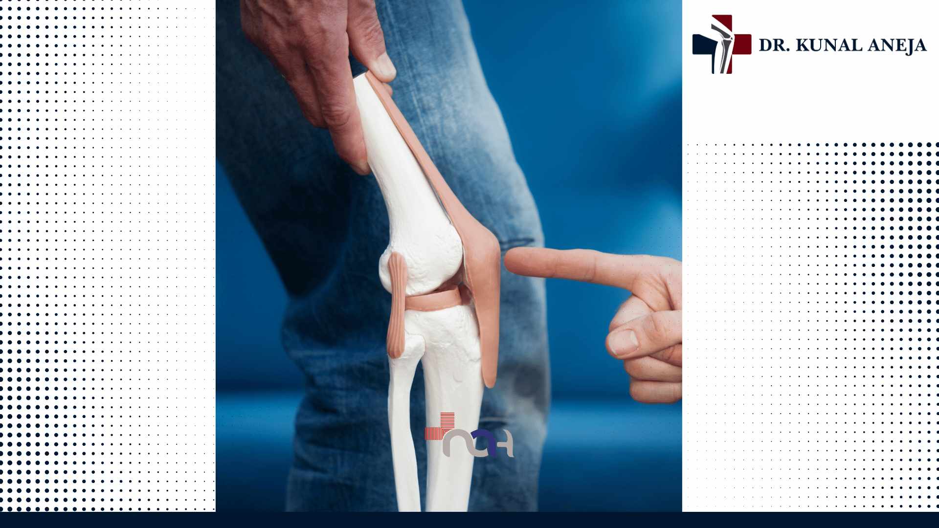 Total Knee Replacement in Delhi