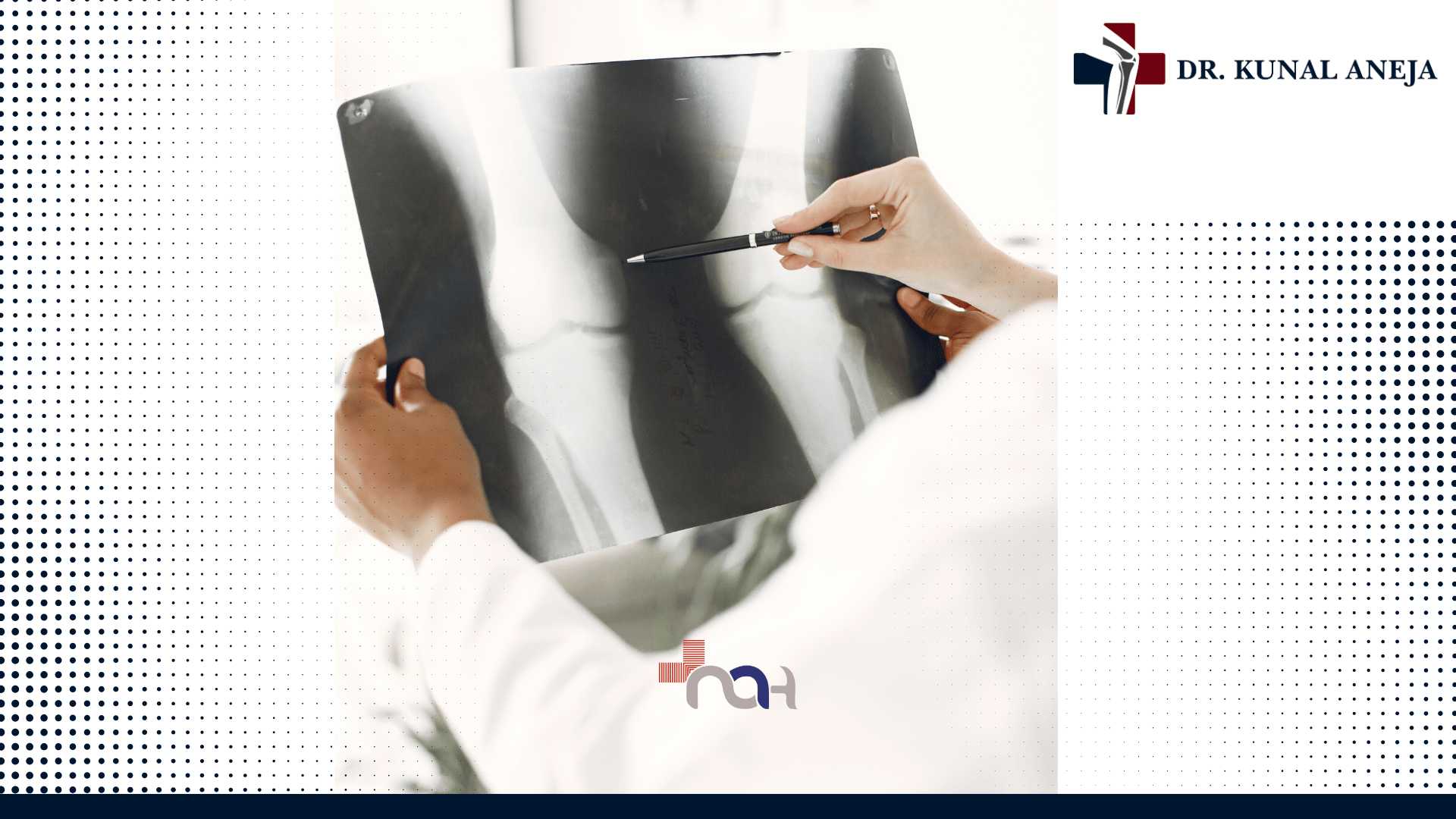 knee replacement surgeon in Delhi