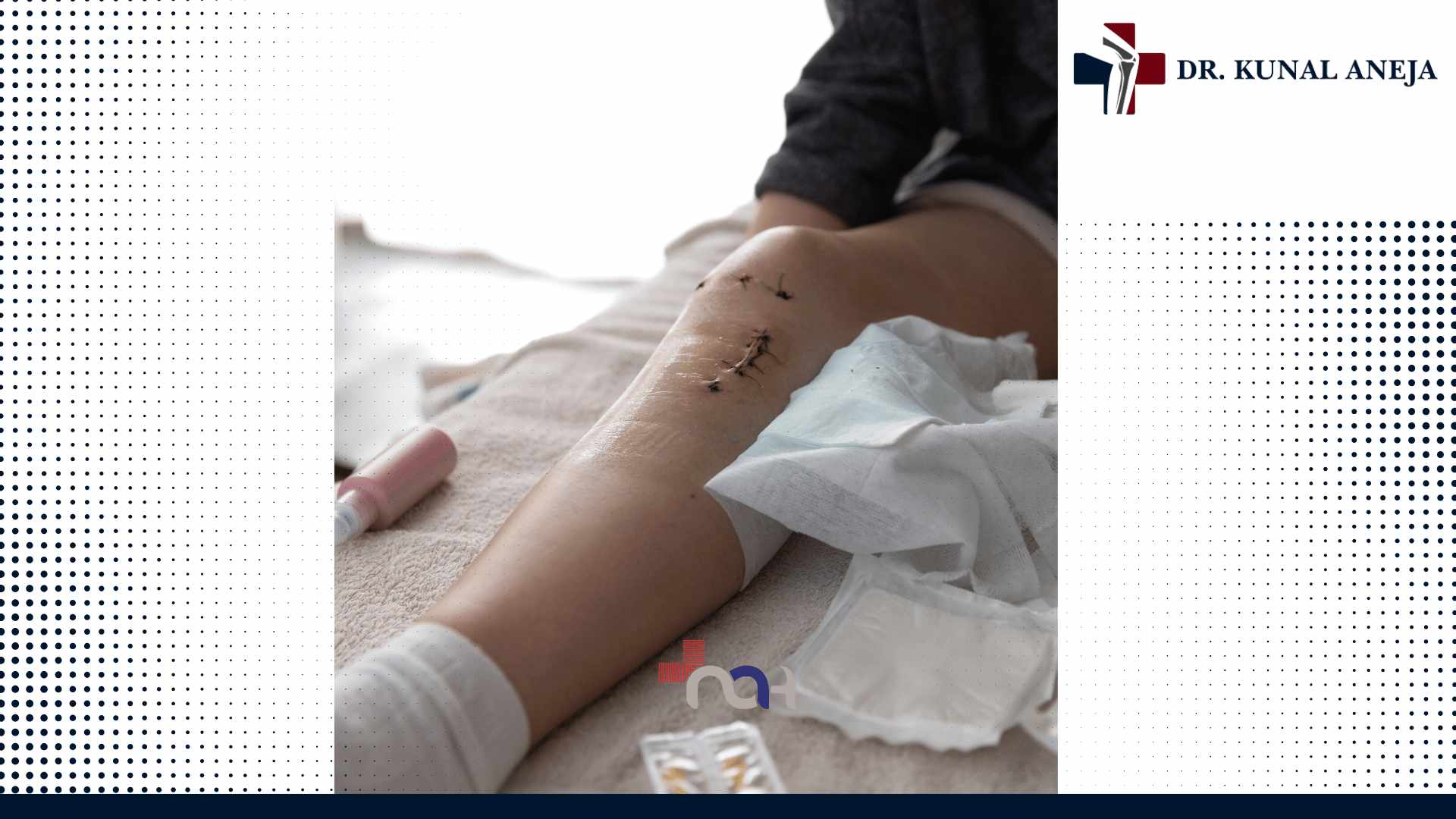 Total Knee Replacement in Delhi