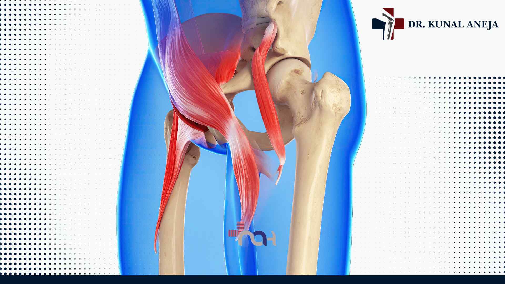 Best Hip Replacement Surgeon in Delhi