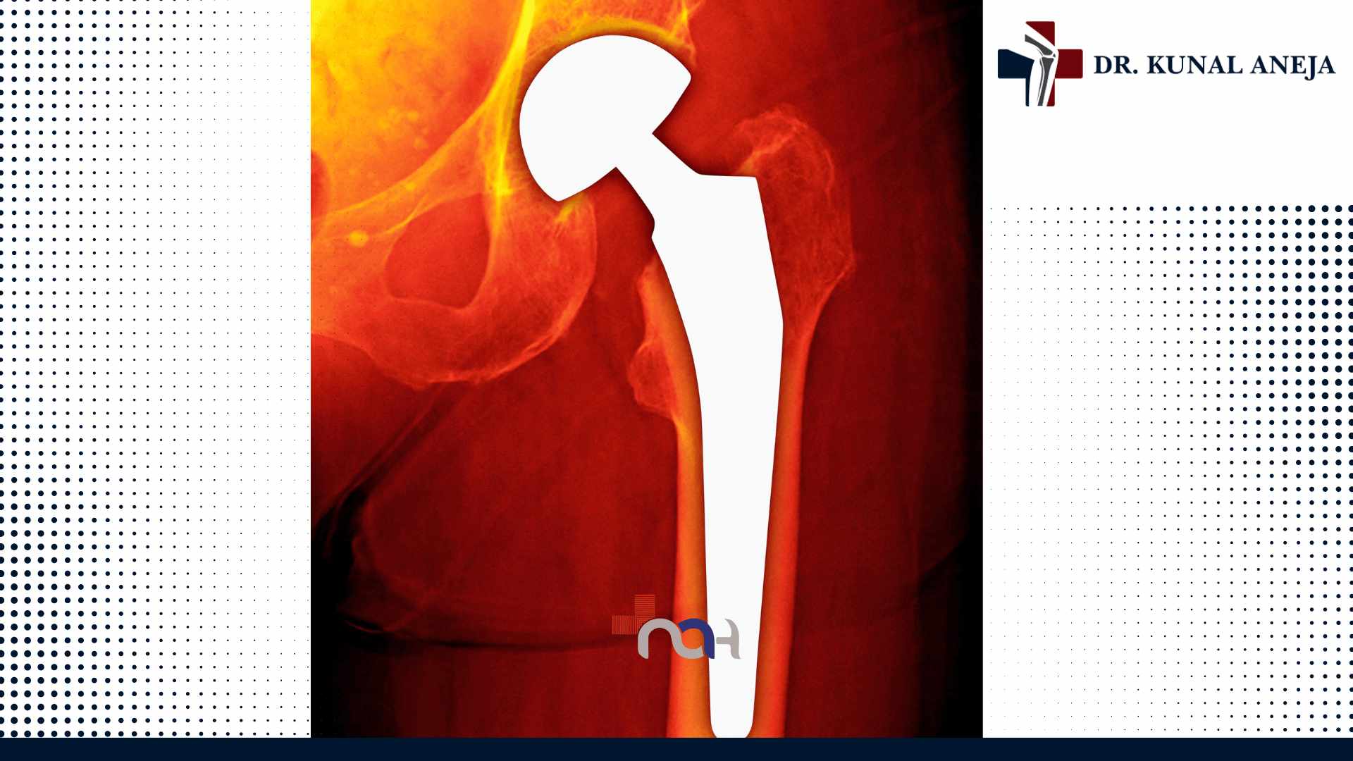 Total Hip Replacement in Delhi