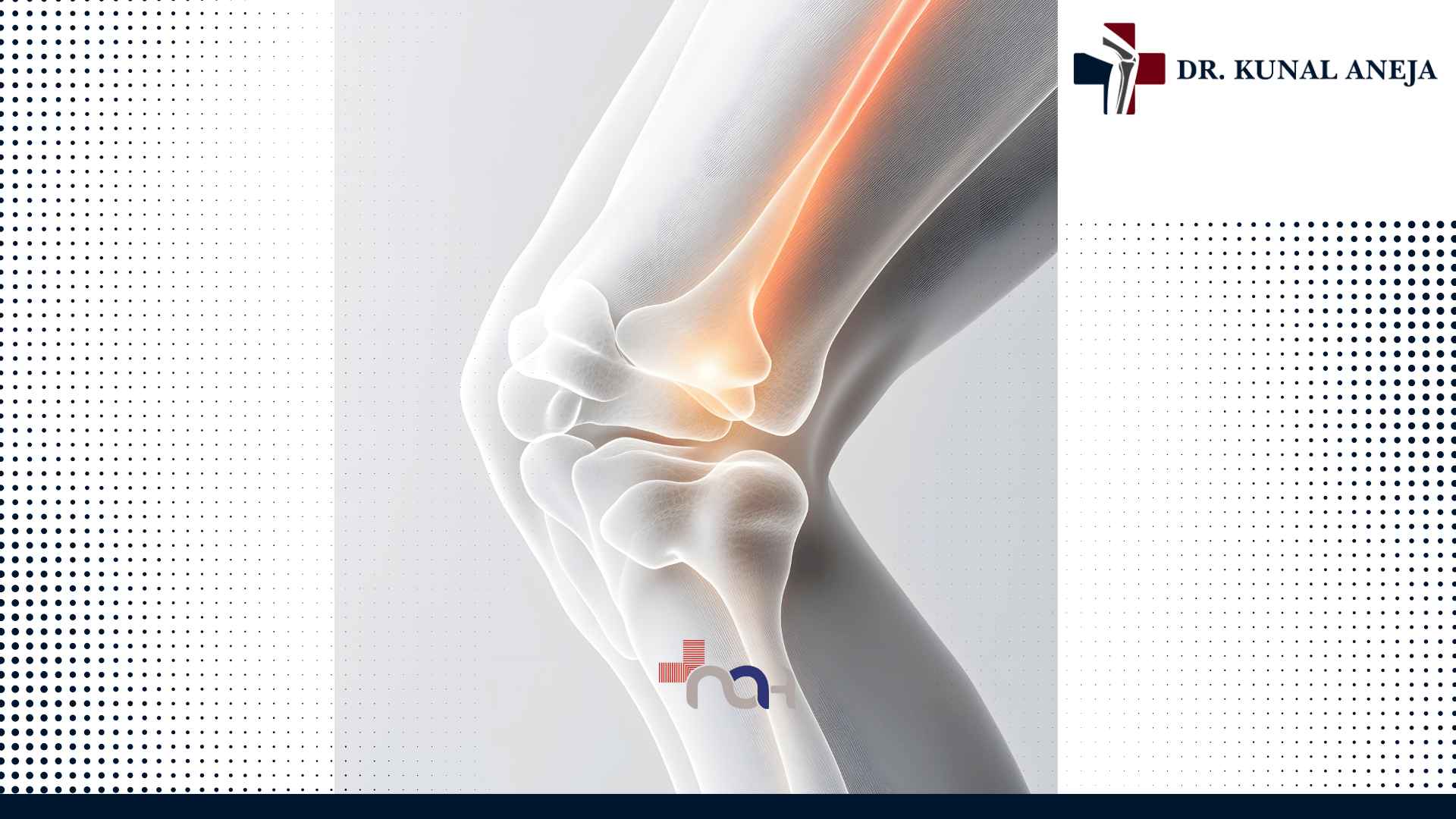 Best Knee Replacement Surgeon in Delhi
