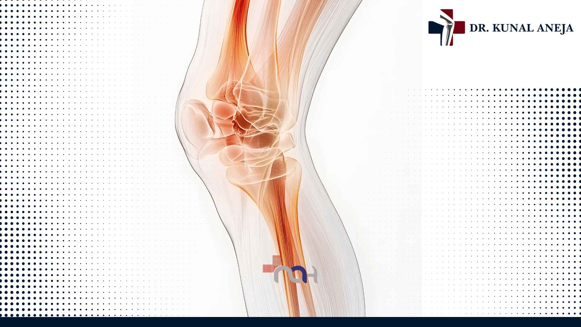 Knee Replacement Surgeon in Delhi