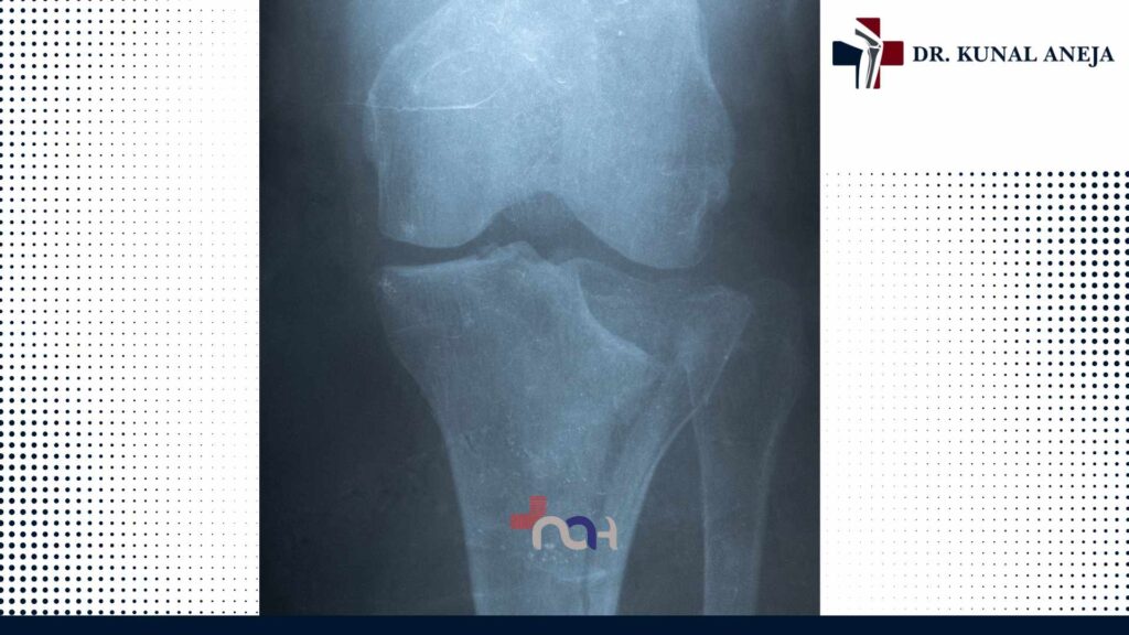 Best Knee Replacement Surgeon in Delhi