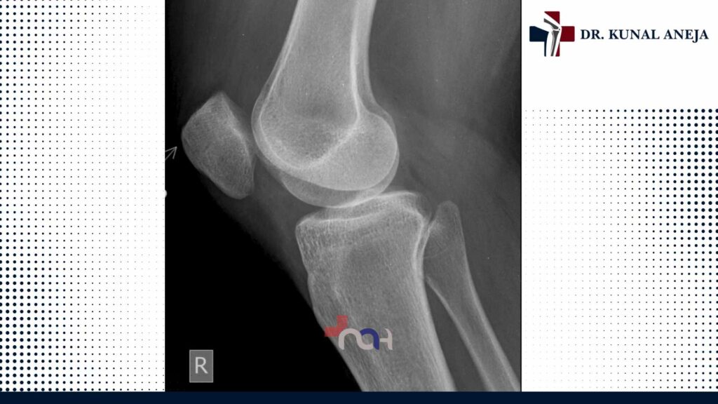 Total Knee Replacement Surgery