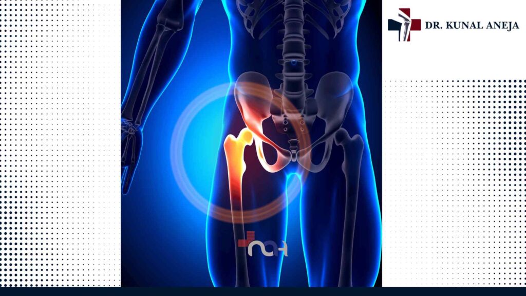 Hip Replacement Surgery