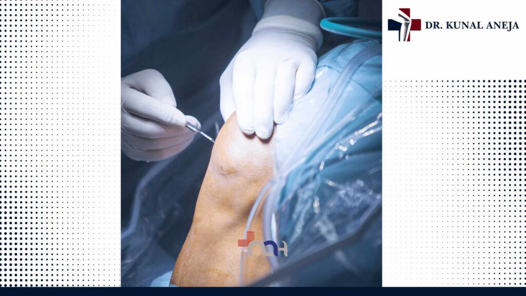 Knee Replacement Surgery