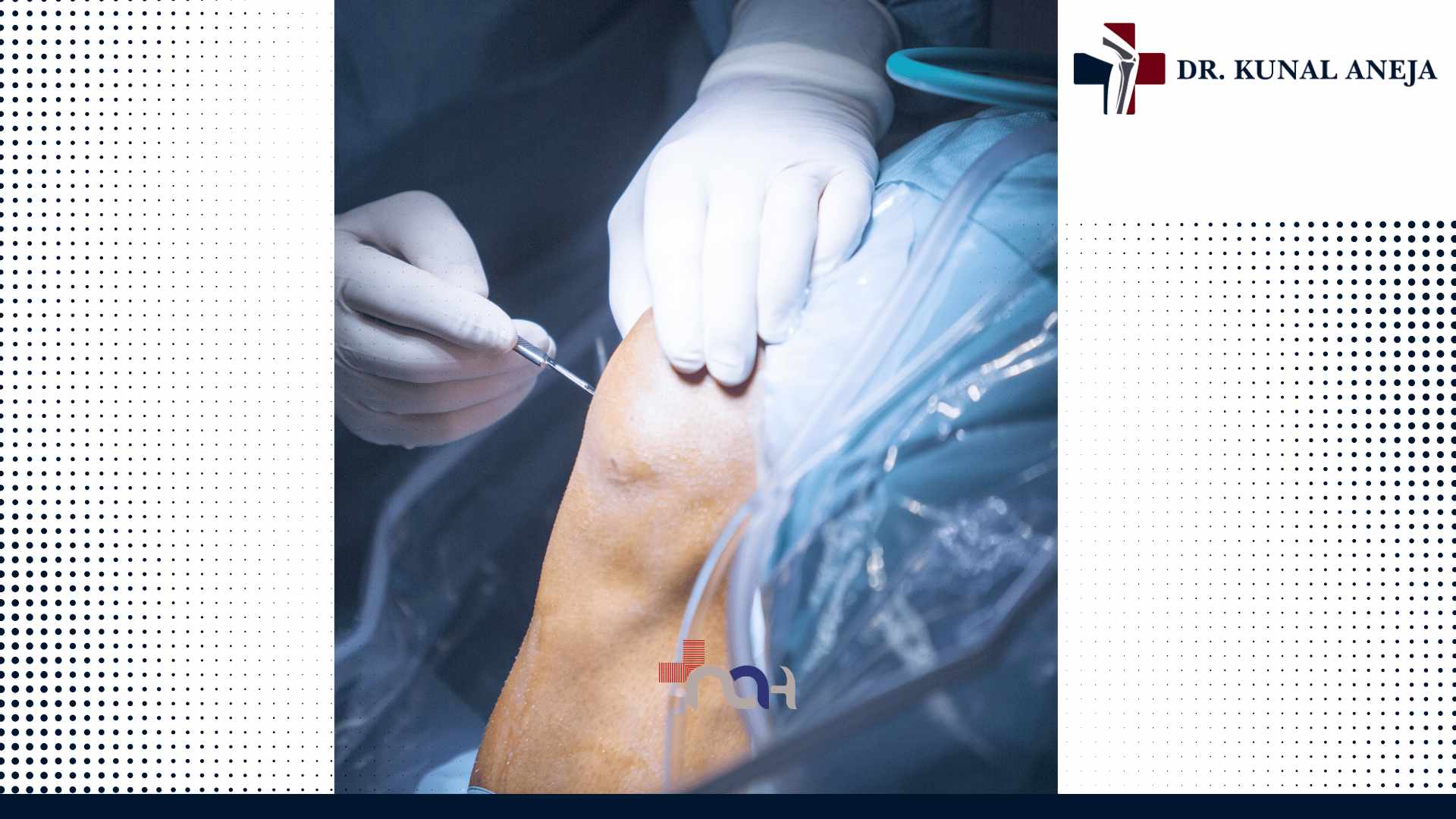 Knee Replacement Surgery