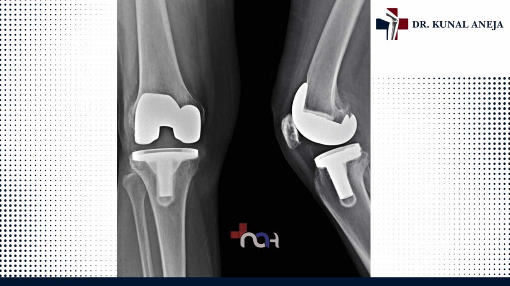 Best Knee Replacement Surgeon in Delhi
