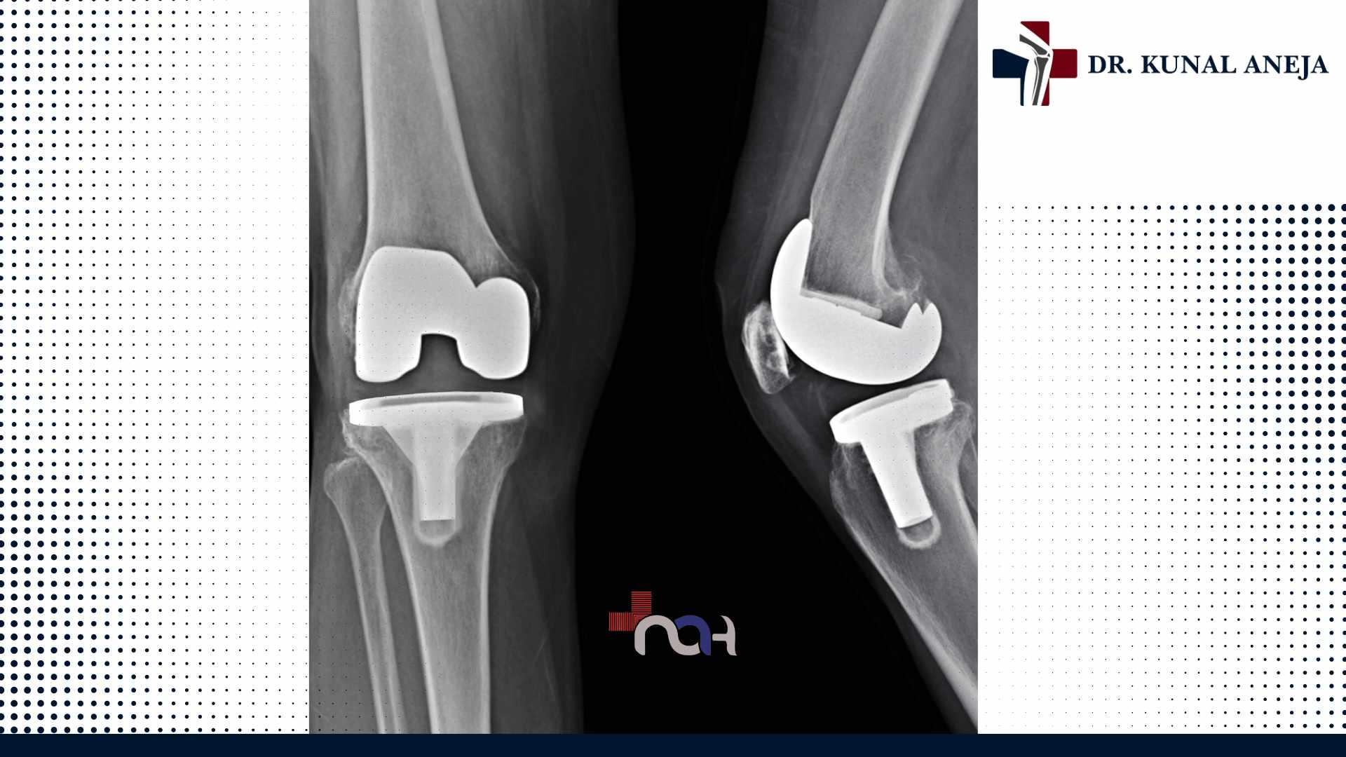 Best Knee Replacement Surgeon in Delhi