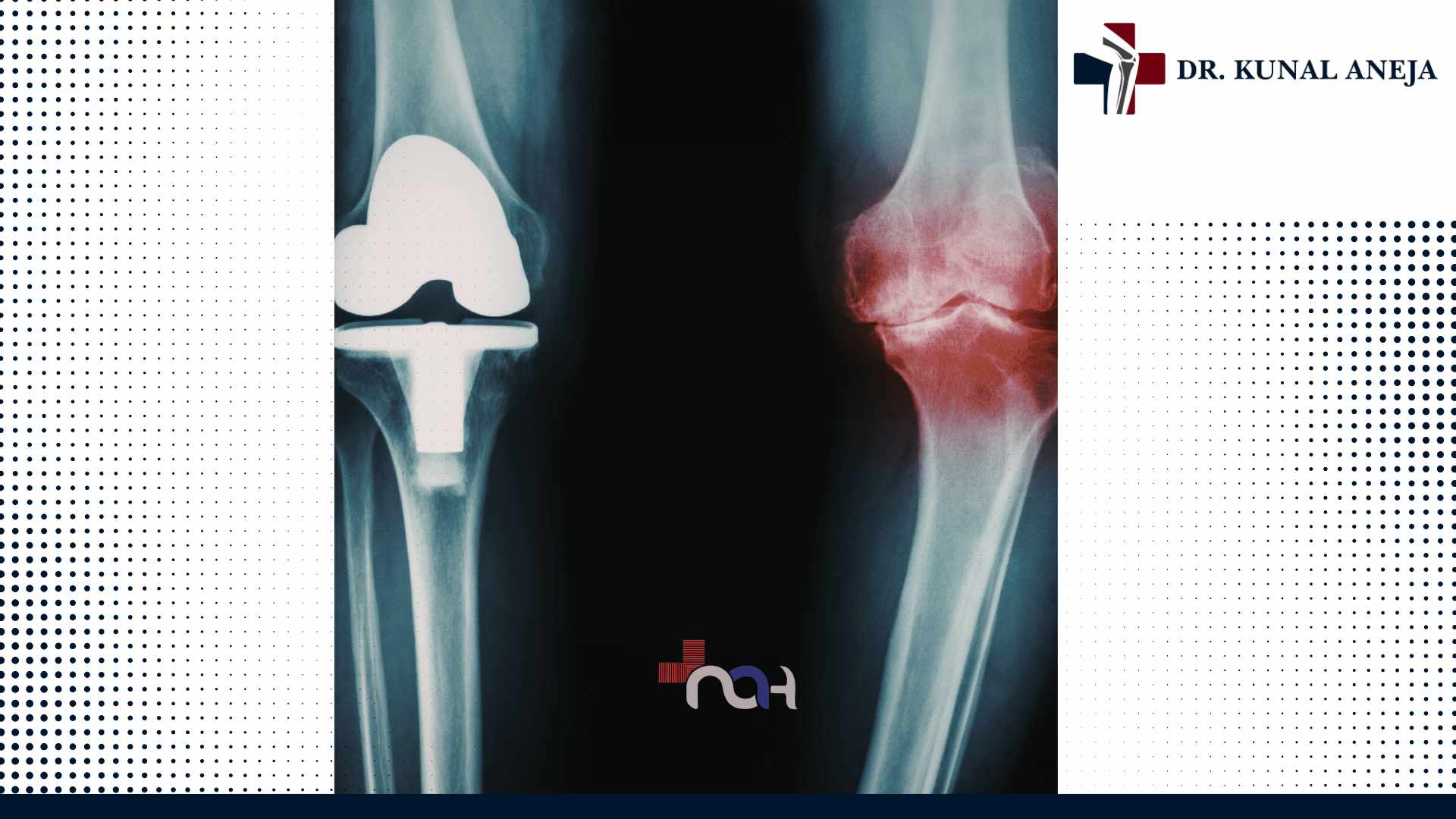 Robotic Knee Replacement Surgery in Delhi
