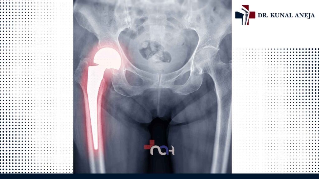 Best Hip Replacement Surgeon in Delhi