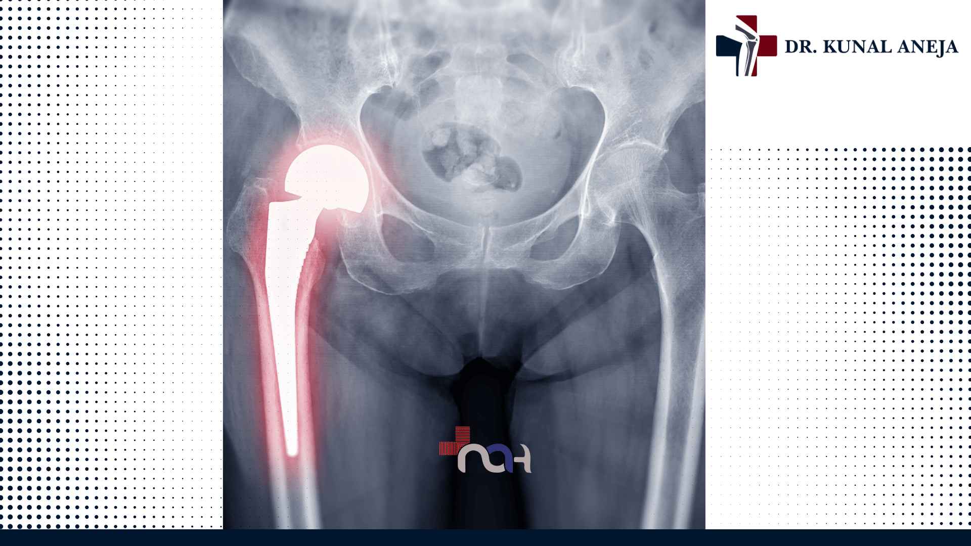 Best Hip Replacement Surgeon in Delhi