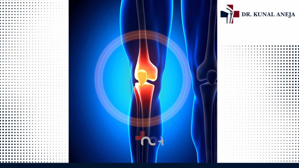 Total Knee Replacement in Delhi