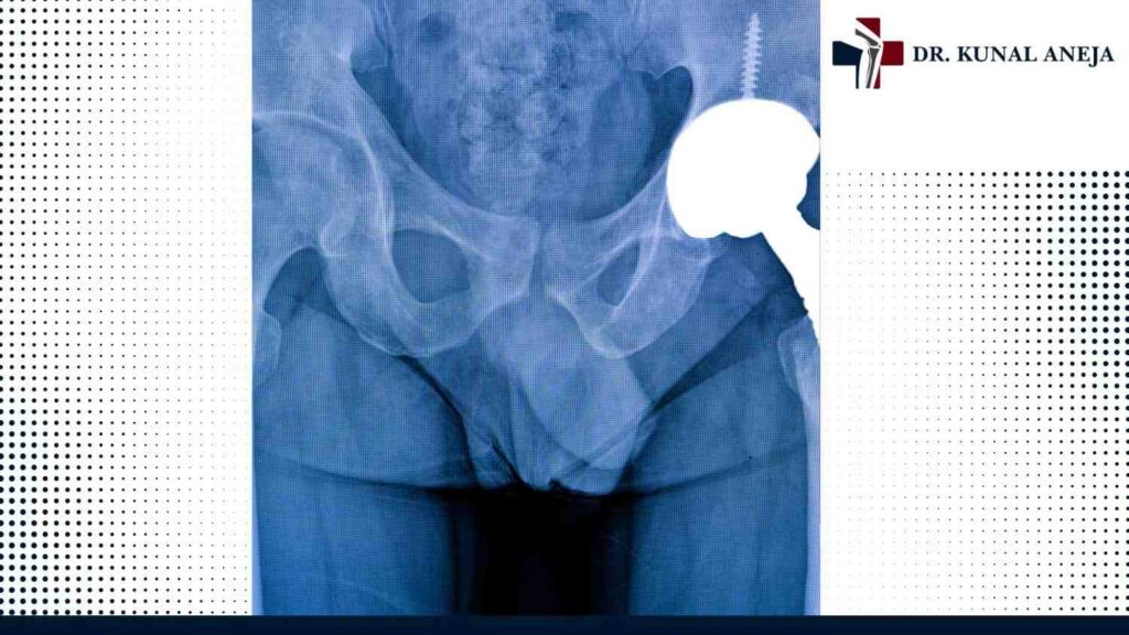 Doctor explaining hip replacement recovery plan to a patient in Delhi
