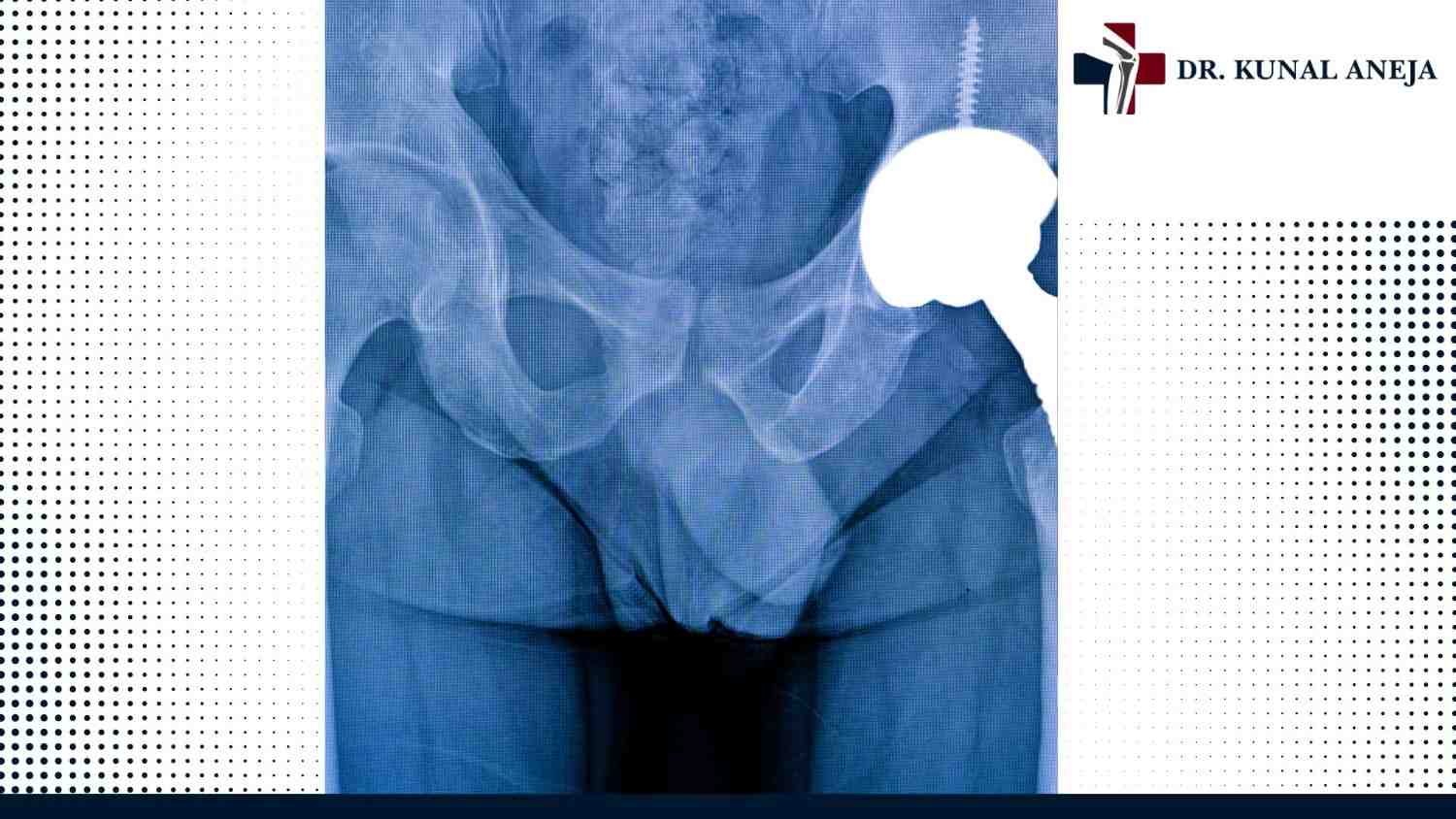 Doctor explaining hip replacement recovery plan to a patient in Delhi