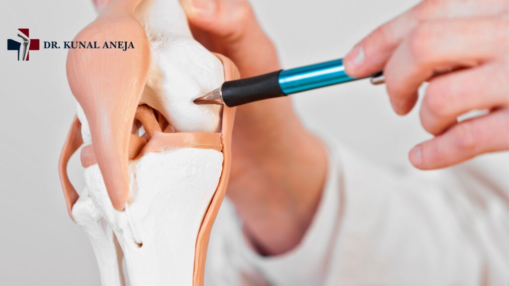  Diagram showing cartilage repair and corrected knee alignment for joint preservation