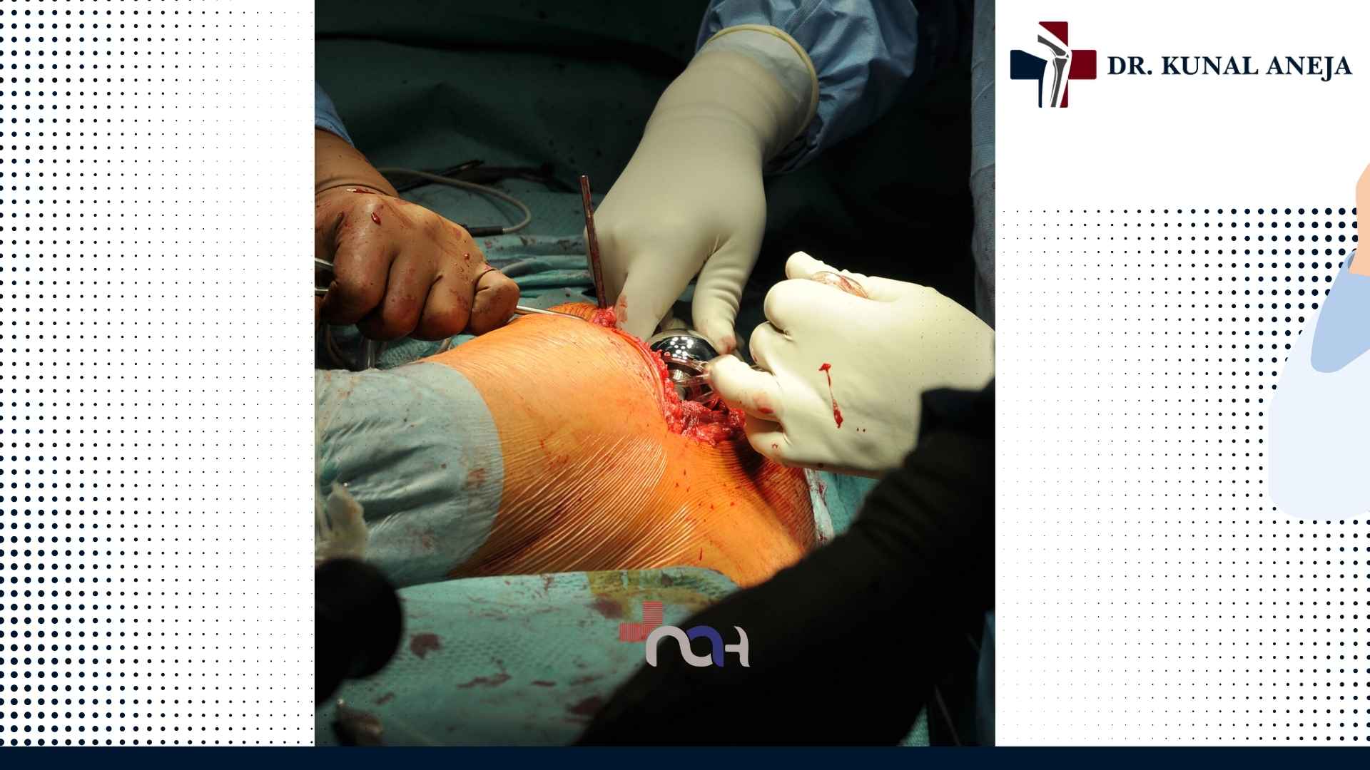 Hip replacement surgeon consultation discussing recovery in Delhi