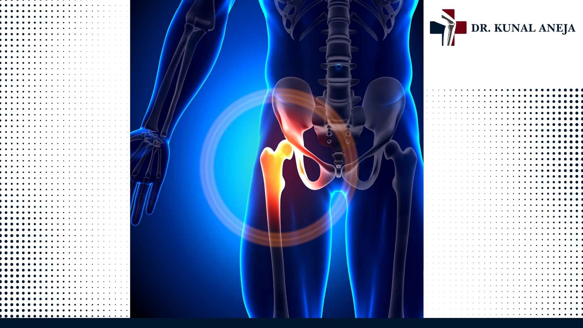 Consultation with a hip replacement surgeon in Delhi