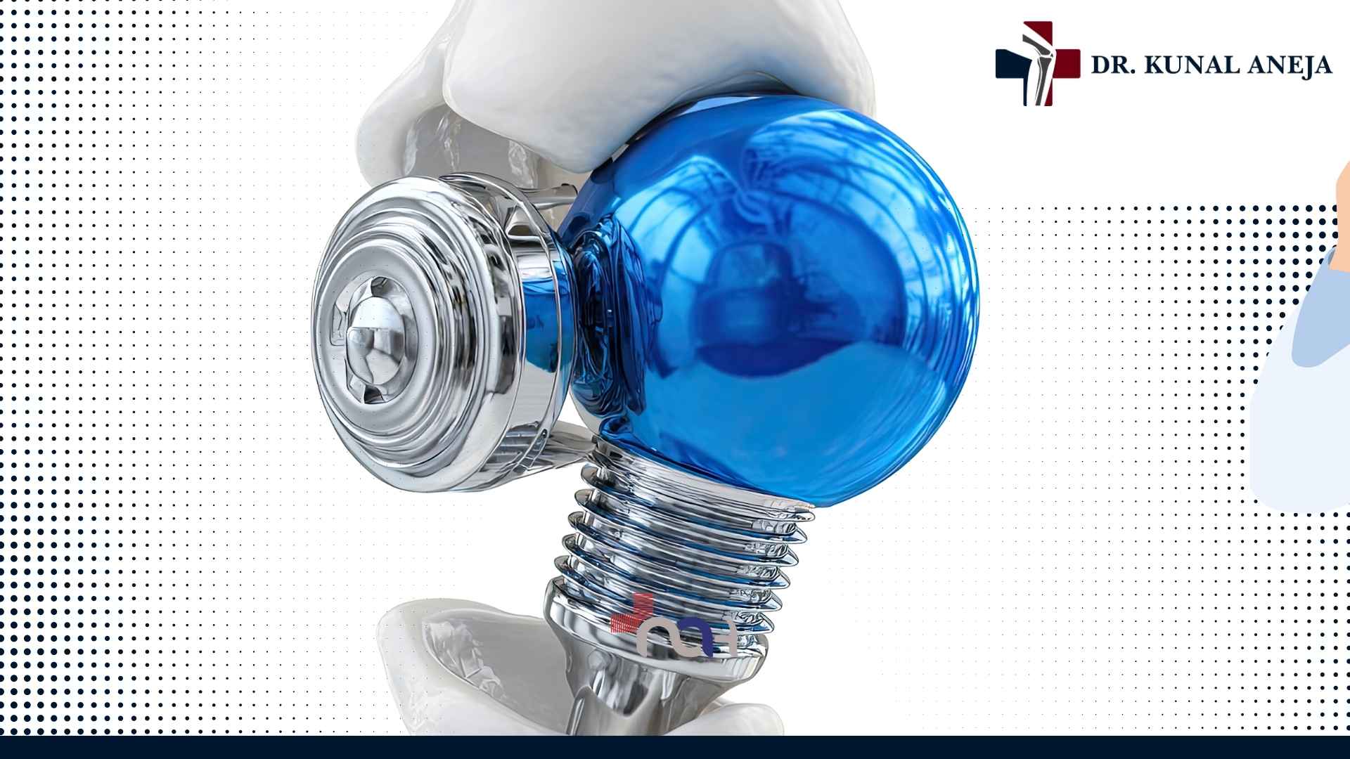 Robotic knee replacement consultation in Delhi