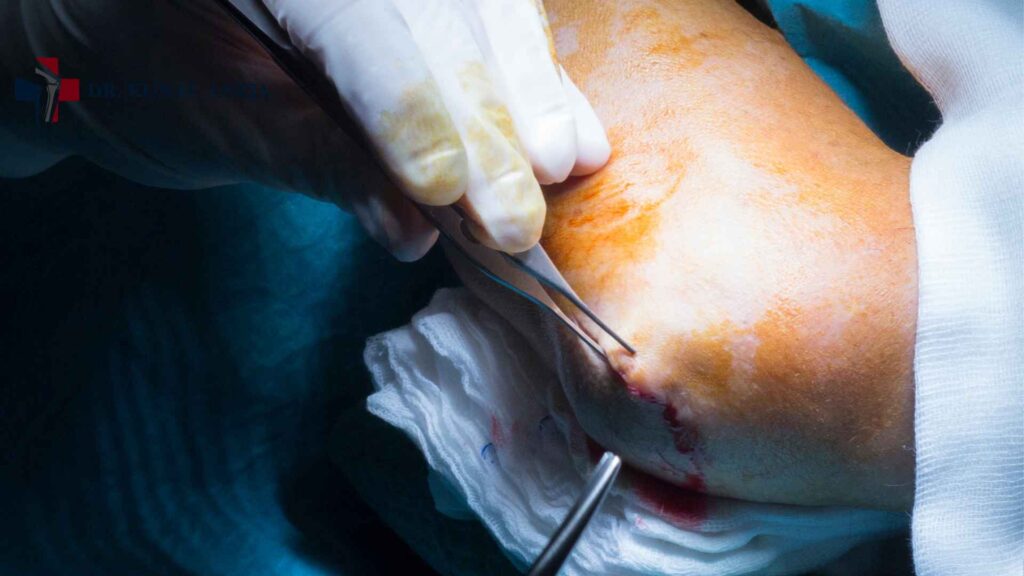 Diagram showing minimally invasive elbow arthroscopy keyhole technique