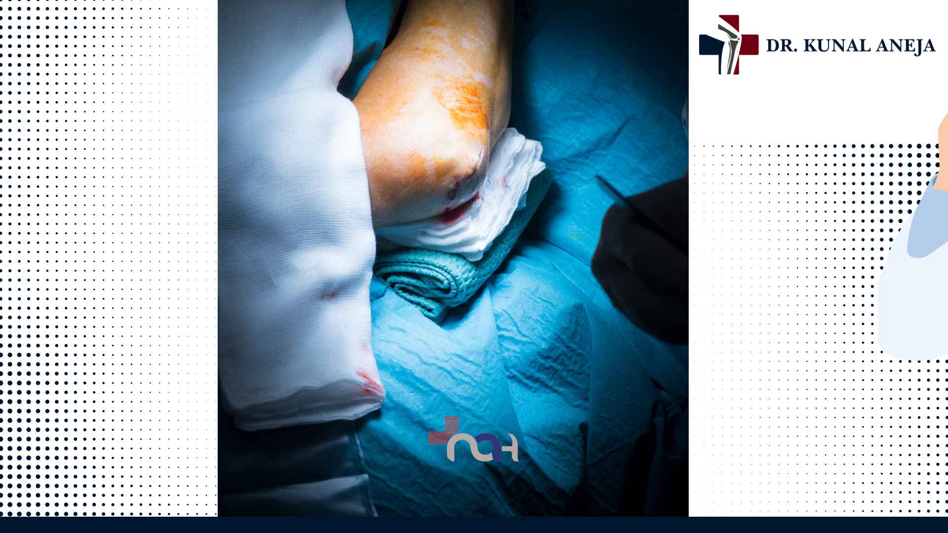 Elbow arthroscopy consultation with Dr Kunal Aneja in Delhi NCR