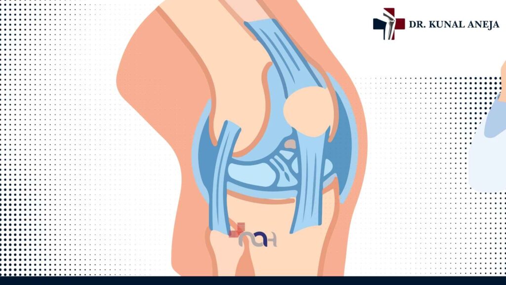 Consultation with Dr. Kunal Aneja, knee replacement surgeon in Delhi