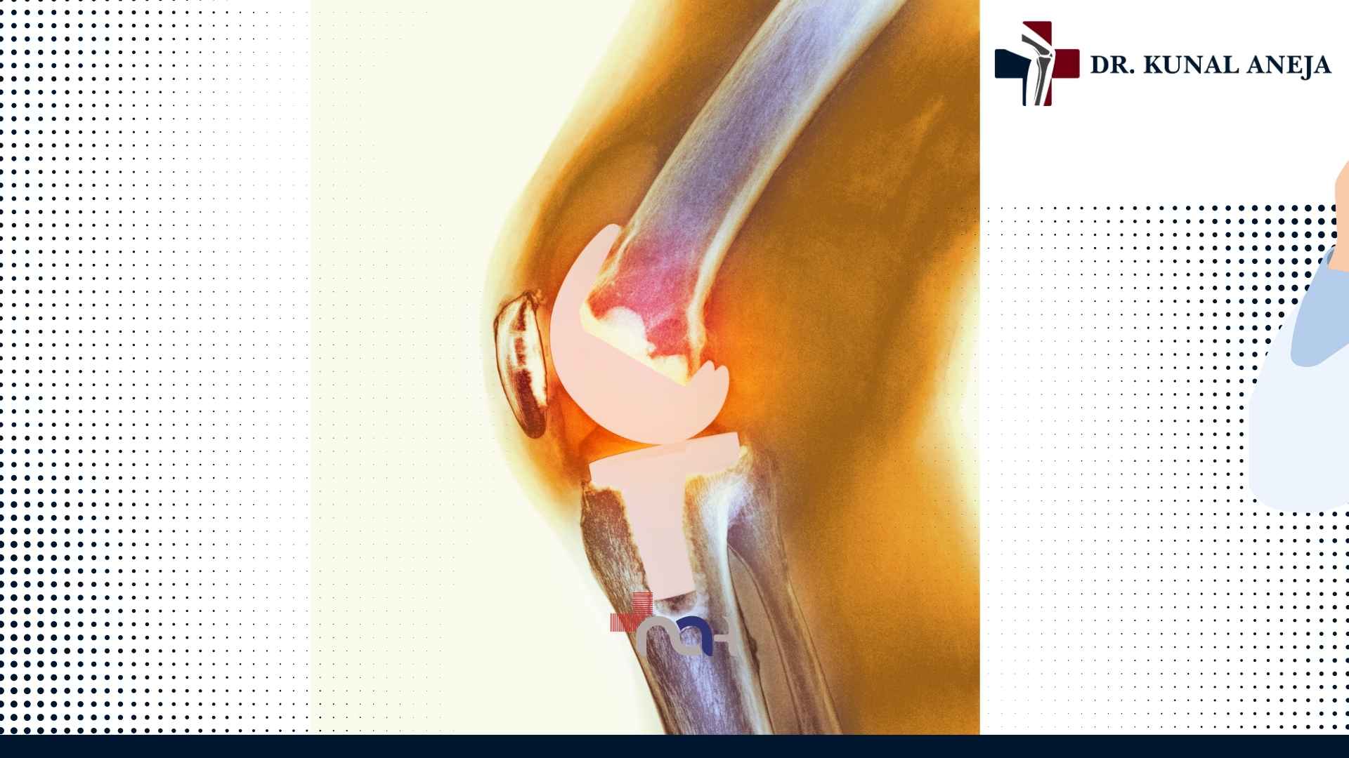 Knee imaging assessment being reviewed during a consultation with Dr. Kunal Aneja
