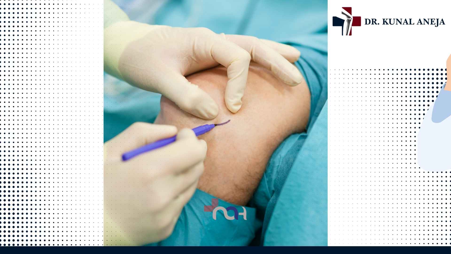 Elbow arthroscopy consultation with Dr. Kunal Aneja near Rohini