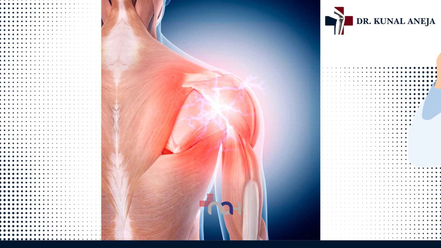 Shoulder Arthroscopy in Delhi: Is Keyhole Surgery for You?